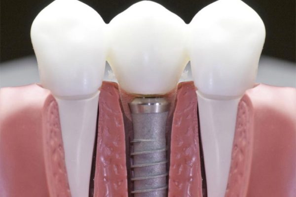 Dental implants